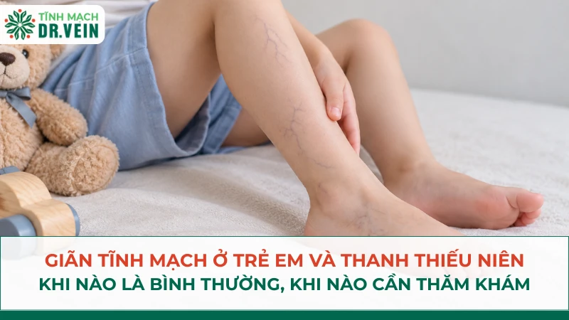 Giãn tĩnh mạch ở trẻ em và thanh thiếu niên: khi nào là bình thường, khi nào cần khám chuyên khoa Giãn tĩnh mạch ở trẻ em và thanh thiếu niên: khi nào là bình thường, khi nào cần khám chuyên khoa
