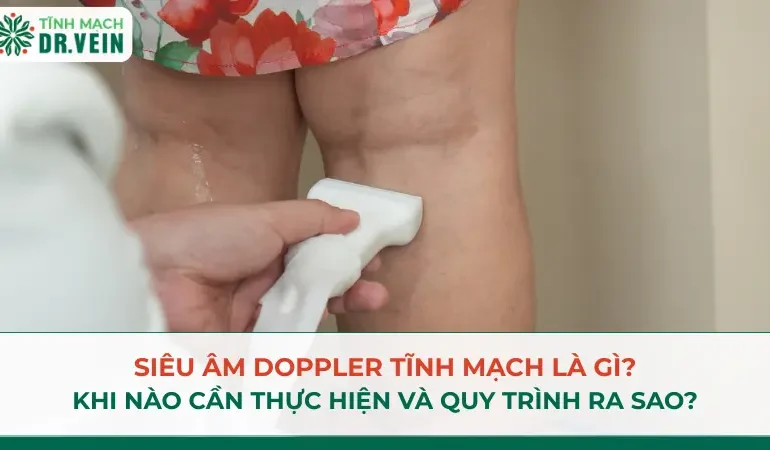 Siêu âm Doppler tĩnh mạch là gì? Khi nào cần thực hiện và quy trình ra sao? Siêu âm Doppler tĩnh mạch là gì? Khi nào cần thực hiện và quy trình ra sao?