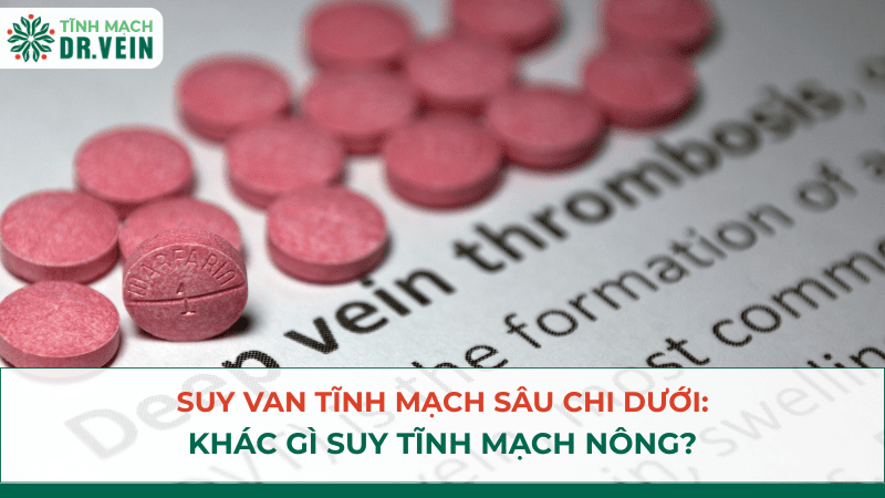 Suy van tĩnh mạch sâu chi dưới: khác gì suy tĩnh mạch nông?