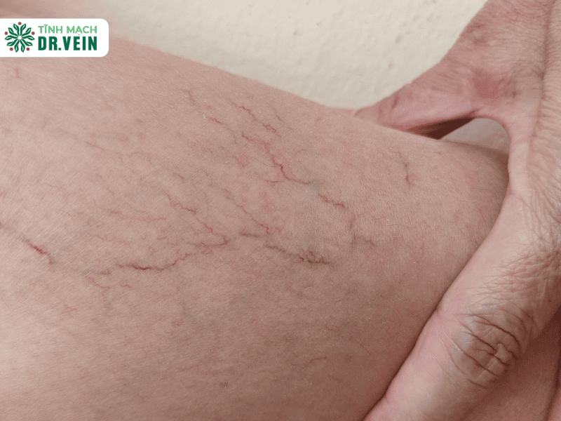 Không phải các mạch máu nhỏ đều là biểu hiện của tái phát suy tĩnh mạch.