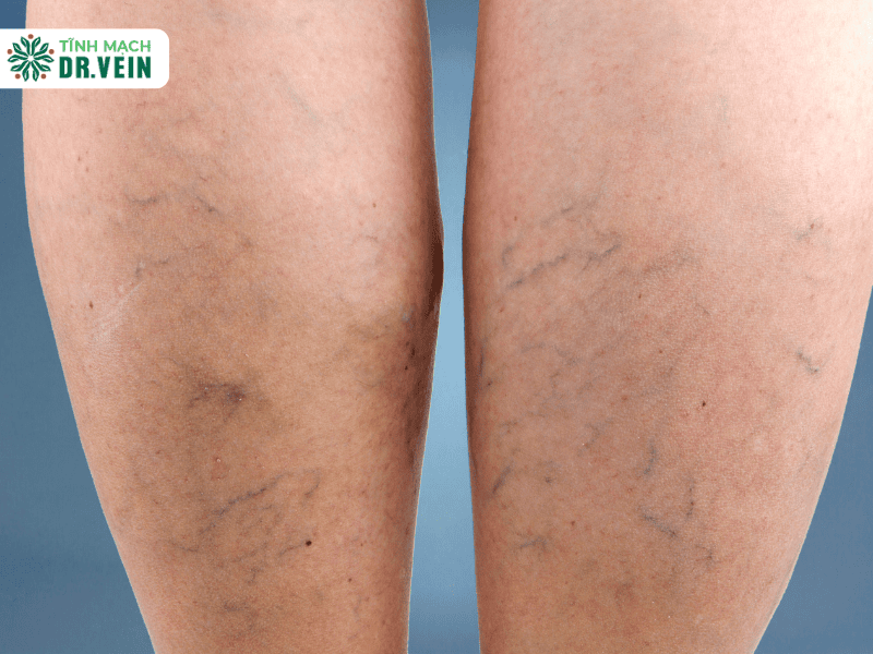 Tĩnh mạch nổi lại sau điều trị có thể do những nguyên nhân nào?