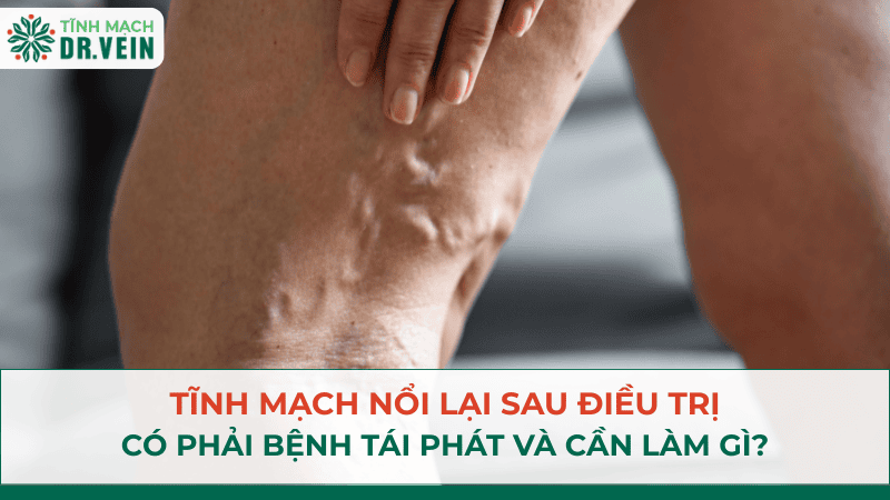 Tĩnh mạch nổi lại sau điều trị: có phải bệnh tái phát và cần làm gì?