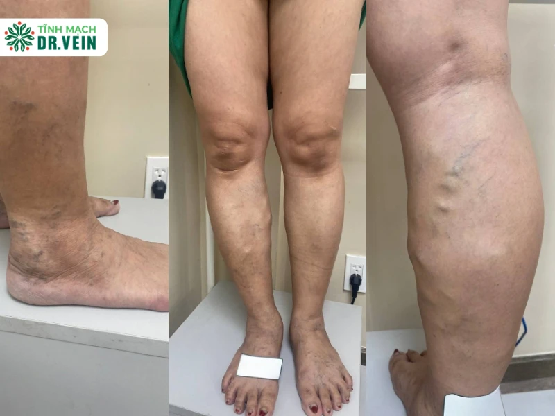 Tái Phát Sau 5 Năm Điều Trị: Việt Kiều Mỹ Phải Bóc Búi 2 Chân Tình Trạng Búi Tĩnh Mạch Không Biến Mất Sau Điều Trị