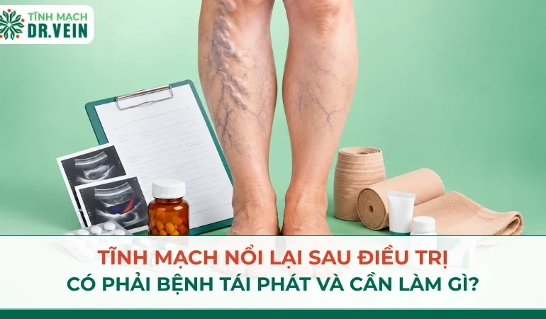 Chuẩn bị trước điều trị giãn tĩnh mạch: thông tin cần biết