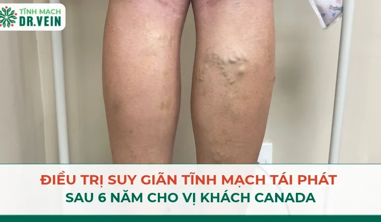 Điều Trị Suy Giãn Tĩnh Mạch Tái Phát Sau 6 Năm Cho Vị Khách Canada Điều Trị Suy Giãn Tĩnh Mạch Tái Phát Sau 6 Năm Cho Vị Khách Canada