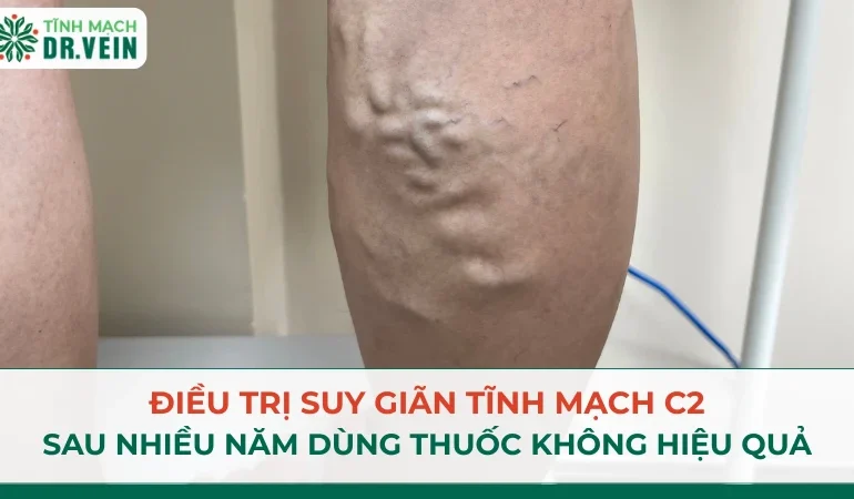 Điều Trị Suy Tĩnh Mạch C2 Sau Nhiều Năm Dùng Thuốc Không Hiệu Quả Điều Trị Suy Tĩnh Mạch C2 Sau Nhiều Năm Dùng Thuốc Không Hiệu Quả