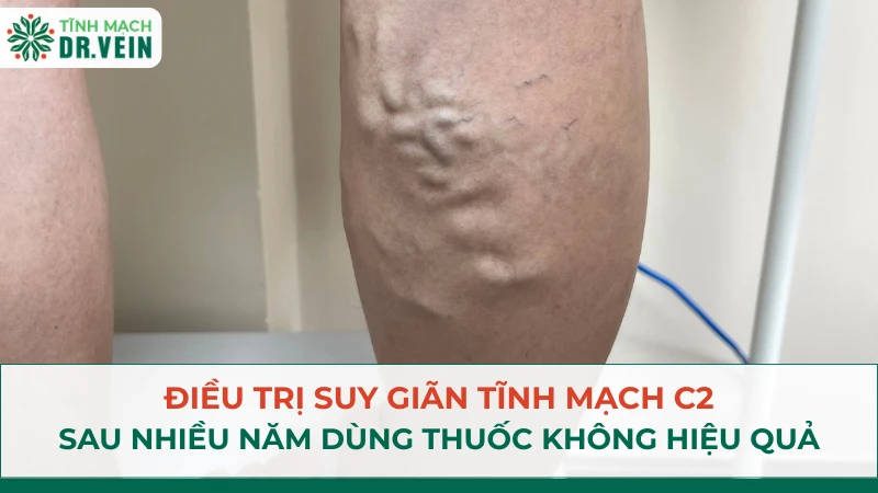 Điều Trị Suy Tĩnh Mạch C2 Sau Nhiều Năm Dùng Thuốc Không Hiệu Quả Điều Trị Suy Tĩnh Mạch C2 Sau Nhiều Năm Dùng Thuốc Không Hiệu Quả