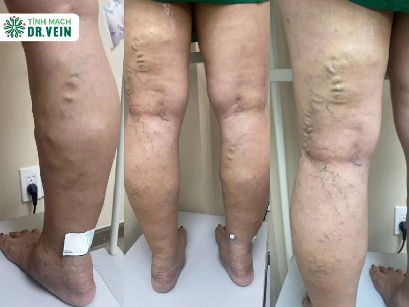 Tái Phát Sau 5 Năm Điều Trị: Việt Kiều Mỹ Phải Bóc Búi 2 Chân tai phat sau dieu tri 1