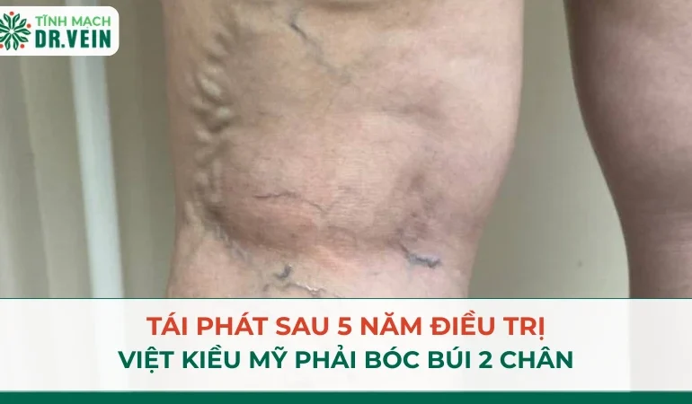 Tái Phát Sau 5 Năm Điều Trị: Việt Kiều Mỹ Phải Bóc Búi 2 Chân Tái Phát Sau 5 Năm Điều Trị: Việt Kiều Mỹ Phải Bóc Búi 2 Chân