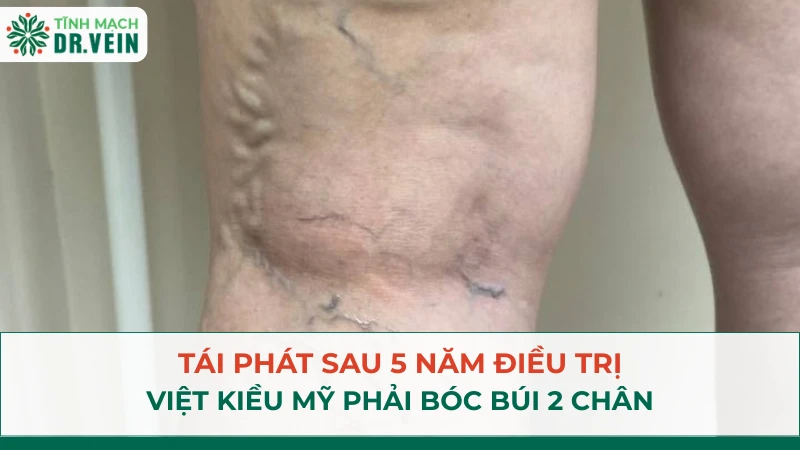Tái Phát Sau 5 Năm Điều Trị: Việt Kiều Mỹ Phải Bóc Búi 2 Chân